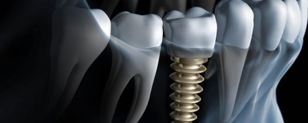 Implant dentaire