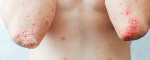 psoriasis
